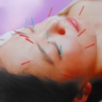 美容面での鍼の活用